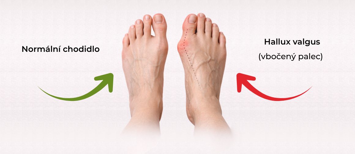 hallux-valgus-normalni-chodidlo-vs-vboceny-palec